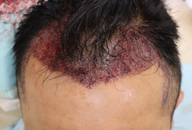 施術直後の生え際の様子