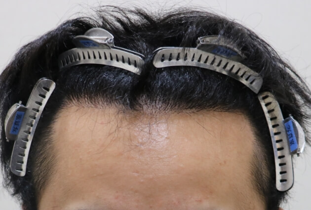 施術6ヶ月後の生え際の様子