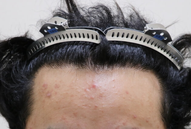 施術1年後の生え際の様子