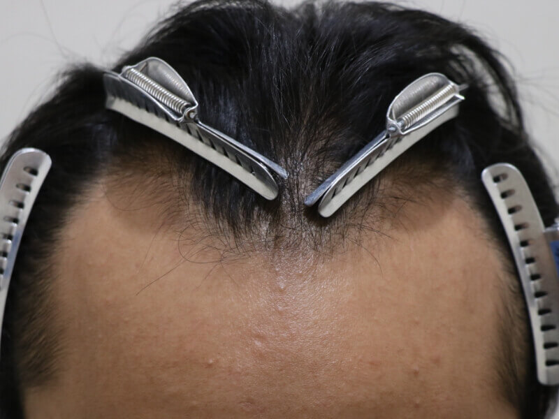 生え際の施術前の様子