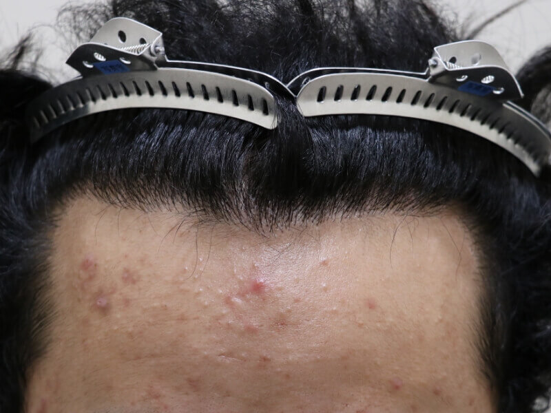 生え際の施術後の様子