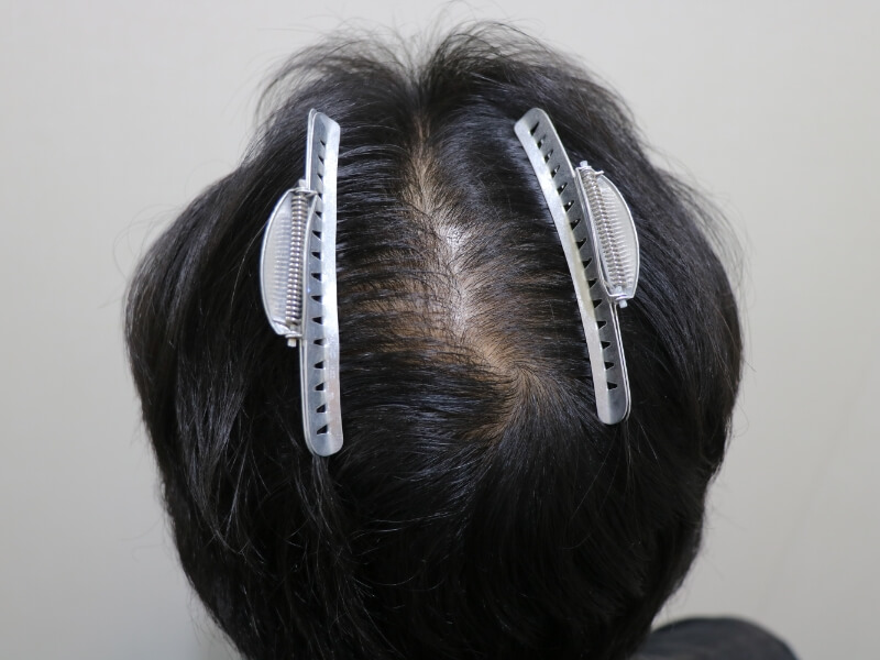 頭頂部の施術前の様子