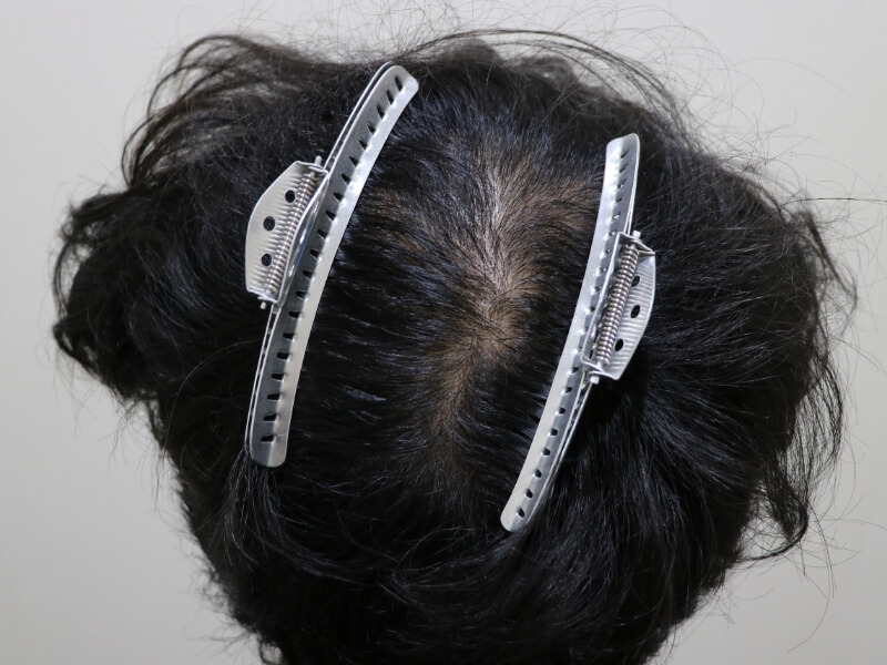 頭頂部の施術後の様子