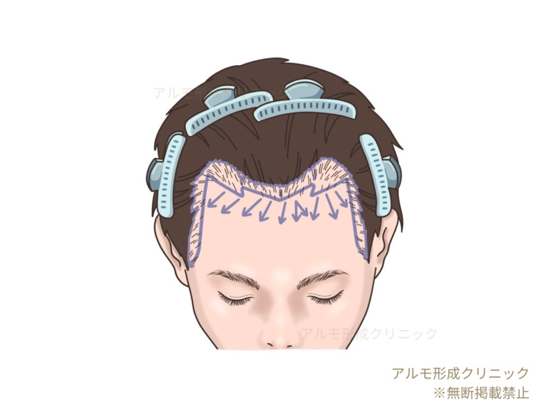 手術前デザインのイラスト