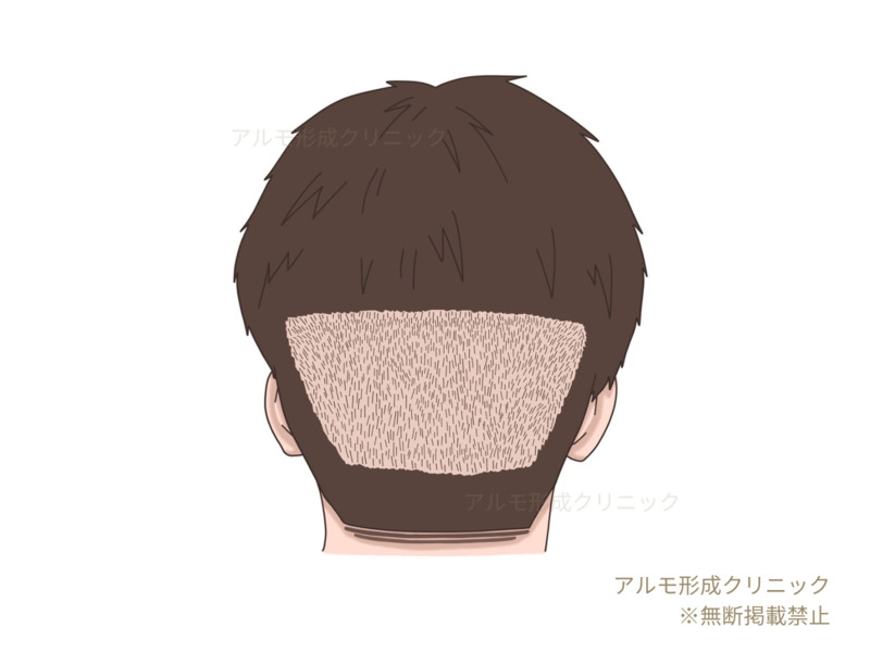 刈り上げ後のイラスト