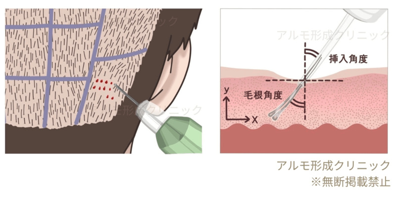 グラフト採取のイラスト・パンチ挿入角度を解説するイラスト