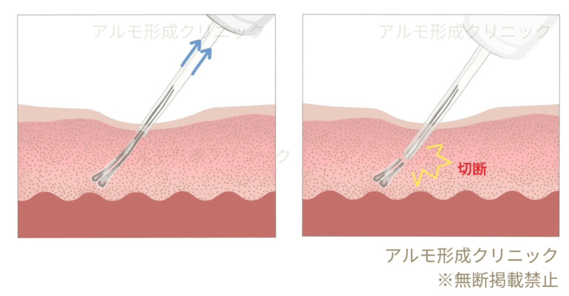 吸引補助システムを解説するイラスト・吸引補助システムがない場合のイラスト