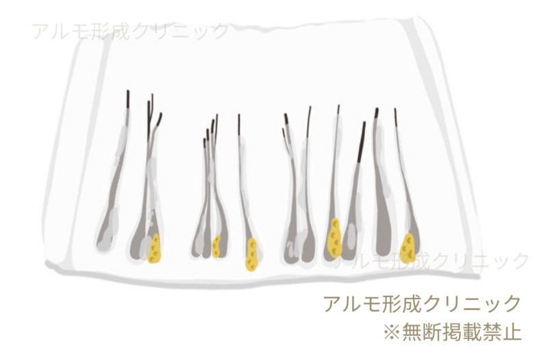 採取後のグラフトのイラスト