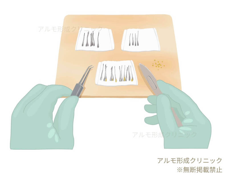 グラフトを選別するイラスト