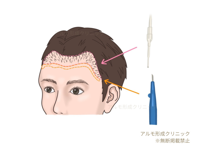 毛穴作成のイラスト