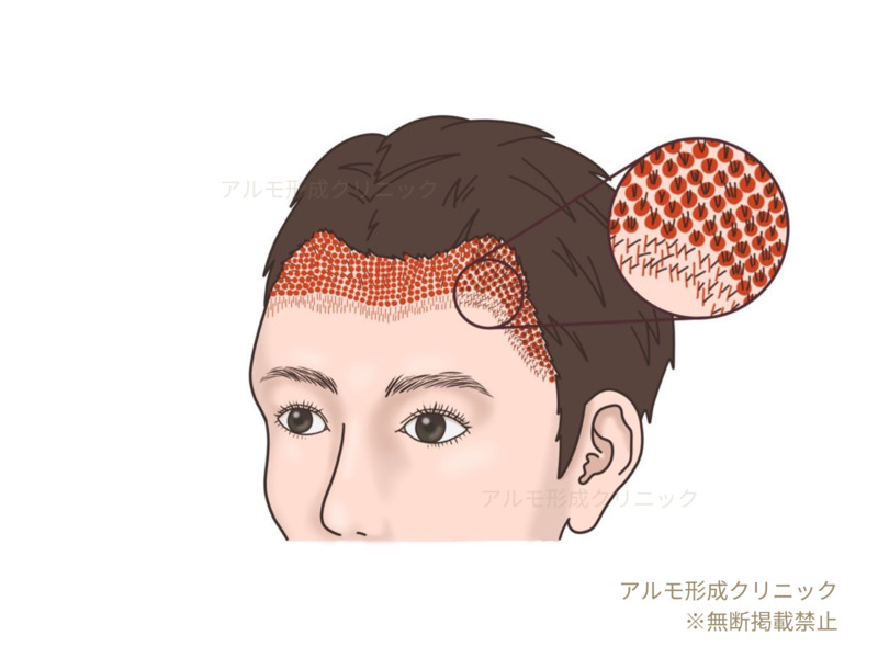 グラフト移植のイラスト