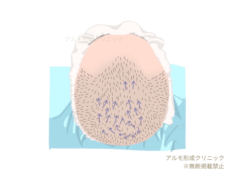 頭頂部移植のイラスト