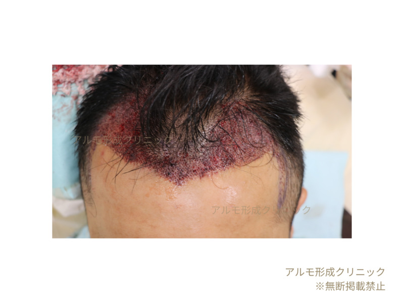 施術完了後の様子