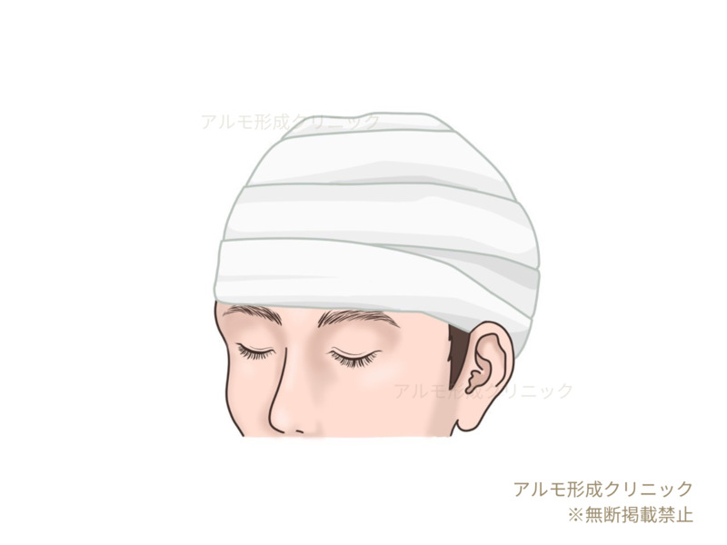 止血作業後のイラスト