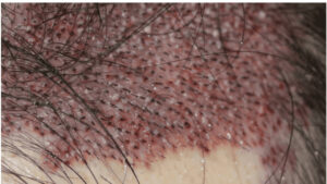 移植床作成のコツとは？