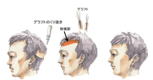 ドナー部をどう評価するか①｜東京 自毛植毛 アルモ形成クリニック 美容外科