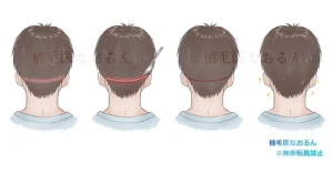 一石二鳥なPunching-Out technique（パンチングアウトテクニック）｜東京 自毛植毛 アルモ形成クリニック 美容外科