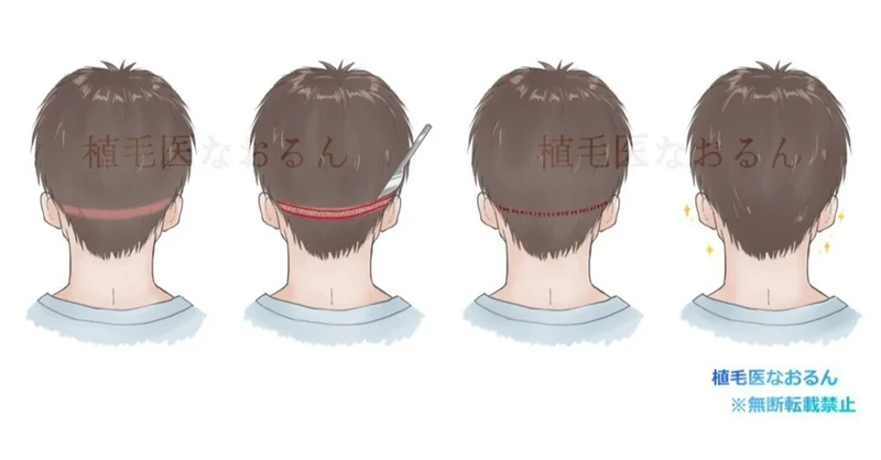 一石二鳥なPunching-Out technique（パンチングアウトテクニック）｜東京 自毛植毛 アルモ形成クリニック 美容外科