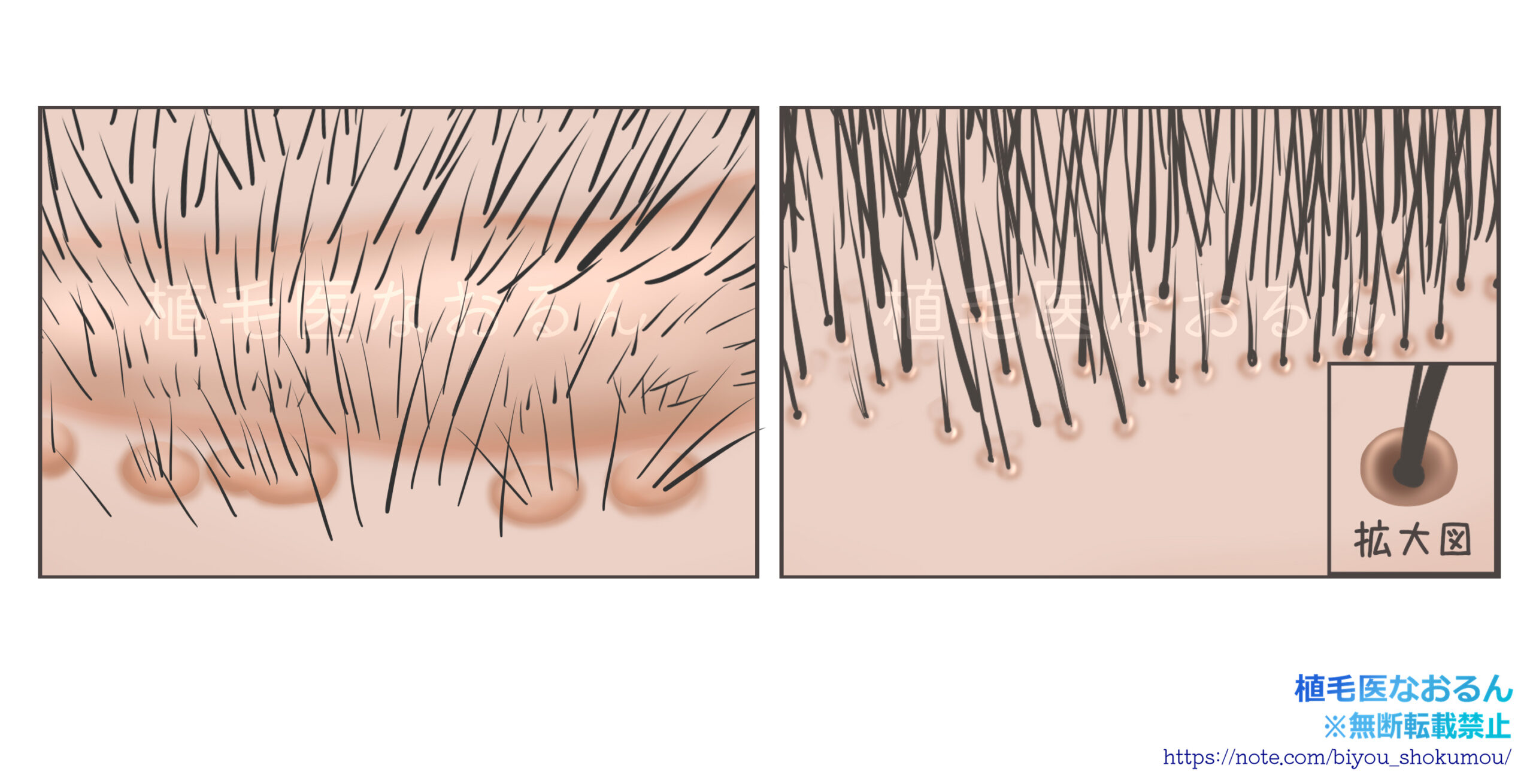 ホールスリットとラインスリットの違い⑤　〜傷跡について〜｜東京 自毛植毛 アルモ形成クリニック 美容外科