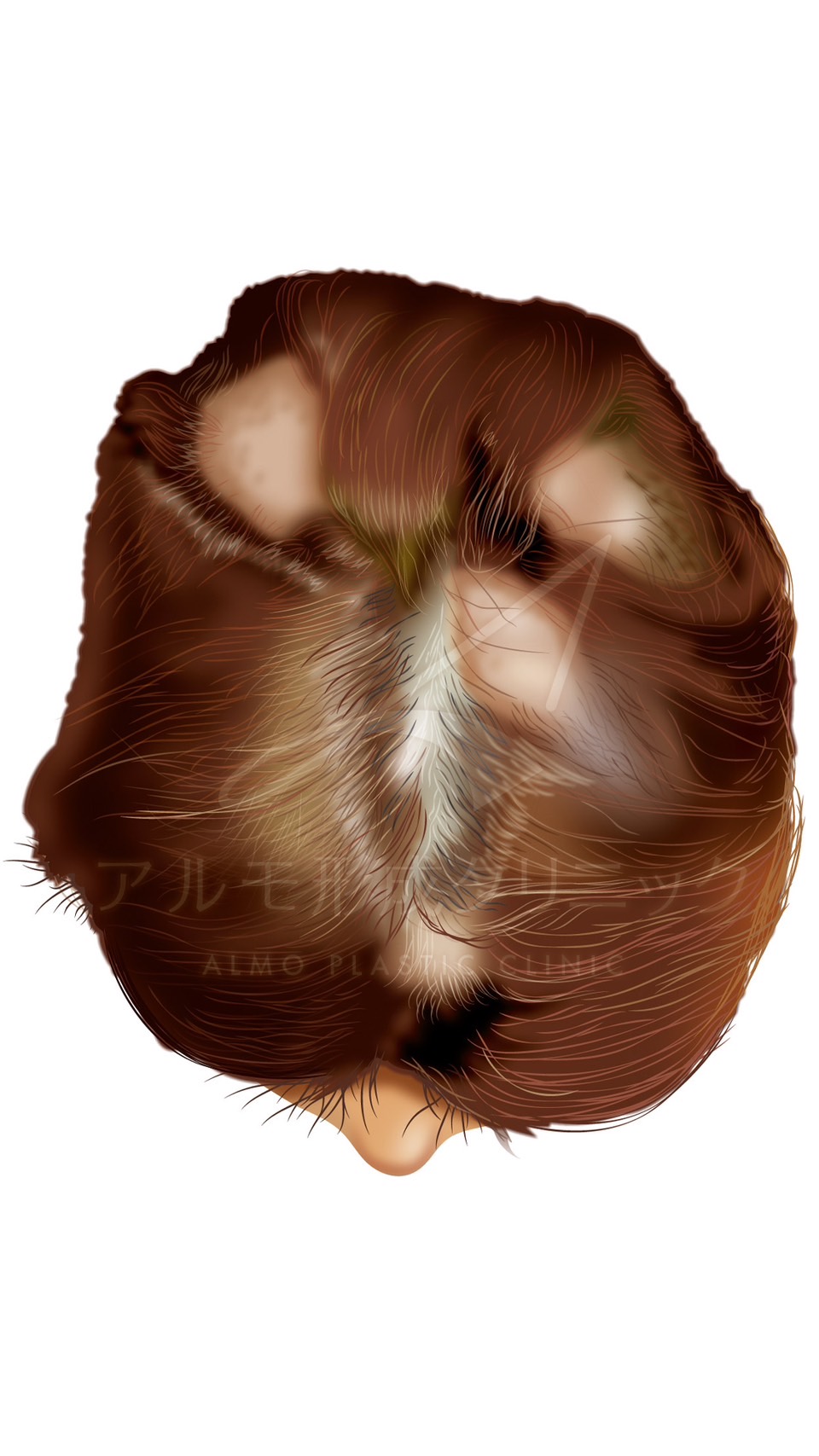 円形脱毛症と自毛植毛について｜東京 自毛植毛 アルモ形成クリニック 美容外科