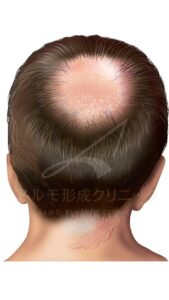 瘢痕性脱毛症①　感染症によるもの｜東京 自毛植毛 アルモ形成クリニック 美容外科