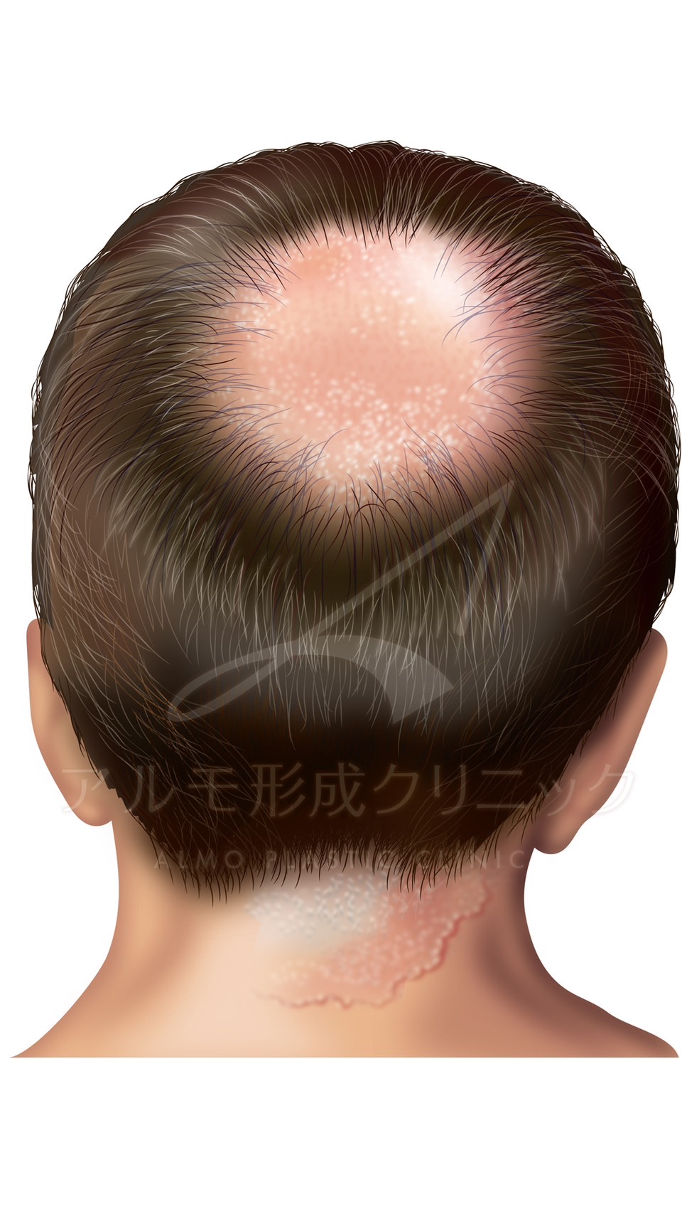 瘢痕性脱毛症①　感染症によるもの｜東京 自毛植毛 アルモ形成クリニック 美容外科