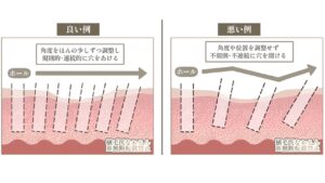 高密度植毛の秘策とは　〜技術編〜｜東京 自毛植毛 アルモ形成クリニック 美容外科