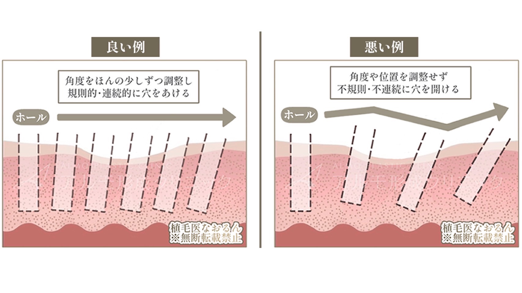 高密度植毛の秘策とは　〜技術編〜｜東京 自毛植毛 アルモ形成クリニック 美容外科