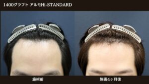 【症例経過】自毛植毛　アルモHi-STANDARD法 1400グラフト　生え際　｜東京 自毛植毛 アルモ形成クリニック 美容外科 院長 内田直宏 先生の施術