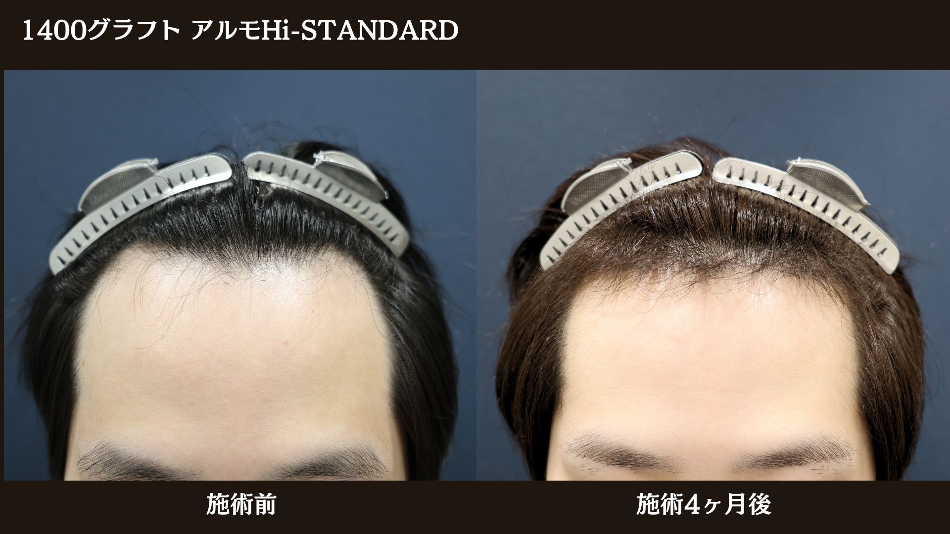 【症例経過】自毛植毛　アルモHi-STANDARD法 1400グラフト　生え際　｜東京 自毛植毛 アルモ形成クリニック 美容外科 院長 内田直宏 先生の施術