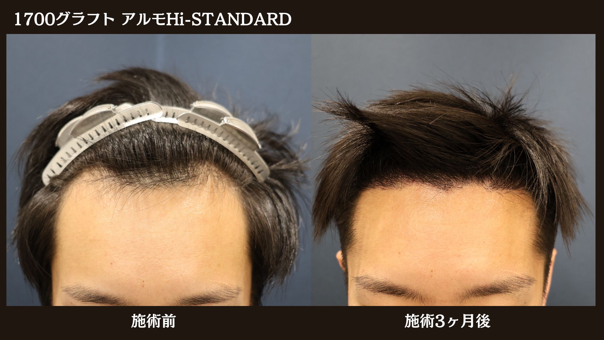 【症例経過】自毛植毛　アルモHi-STANDARD法 1700グラフト　生え際｜東京 自毛植毛 アルモ形成クリニック 美容外科 院長 内田直宏 先生の施術