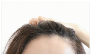 額縮小術のモニター様 募集！｜東京 自毛植毛 アルモ形成クリニック 美容外科