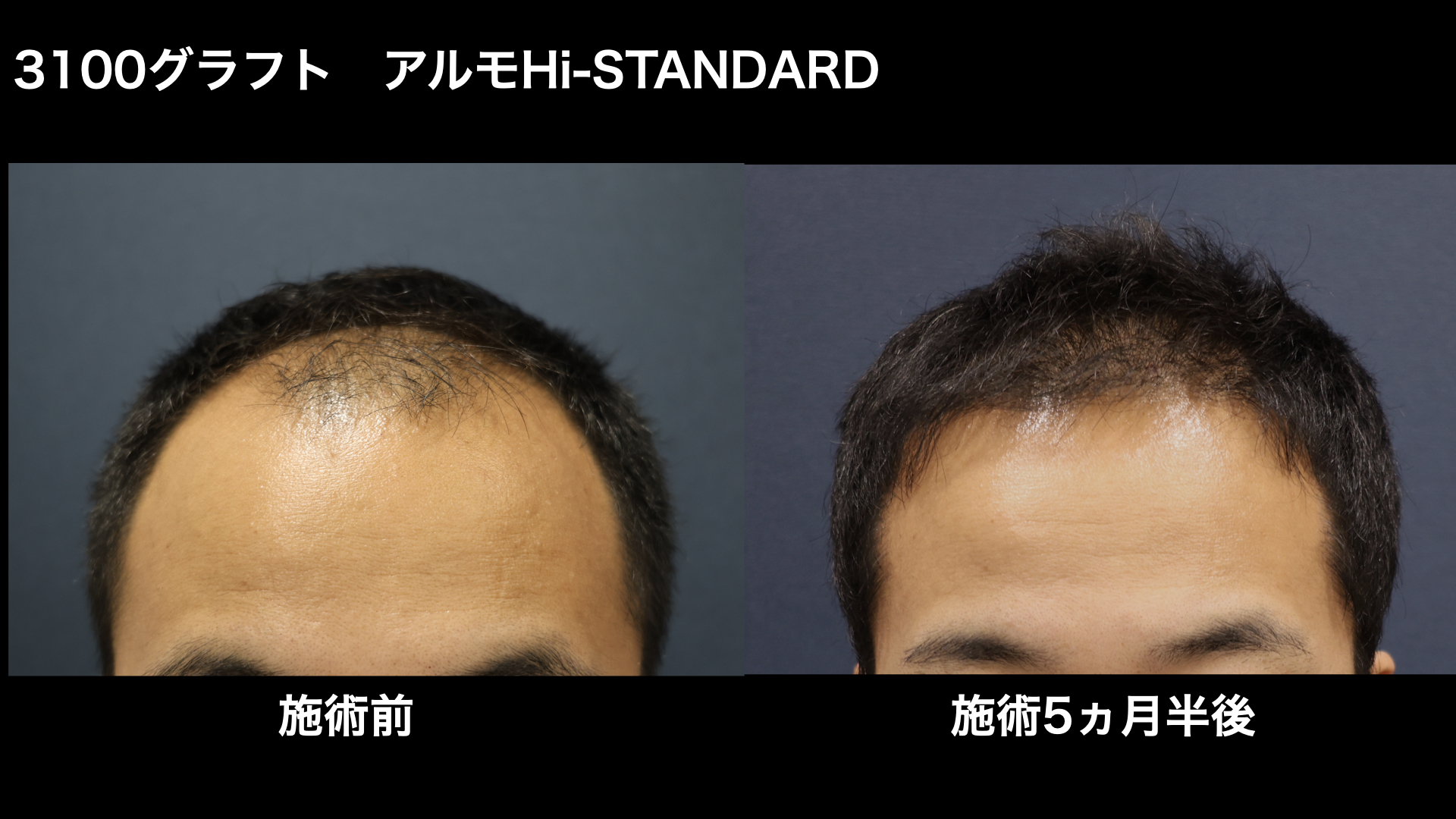 【症例経過】自毛植毛　アルモHi-STANDARD法 3100グラフト　生え際　術後5ヵ月半｜東京 自毛植毛 アルモ形成クリニック 美容外科 院長 内田直宏 先生の施術