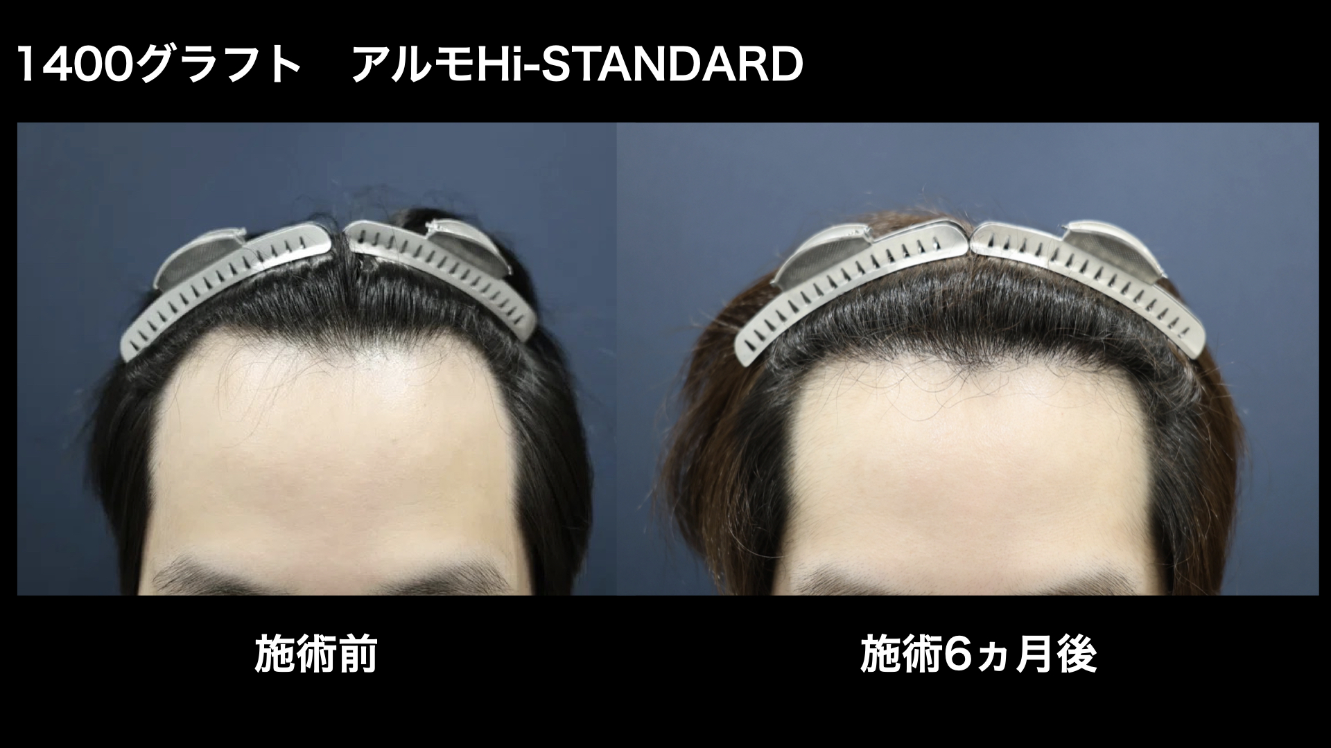 【症例経過】自毛植毛　アルモHi-STANDARD法 1400グラフト　生え際　術後6ヵ月｜東京 自毛植毛 アルモ形成クリニック 美容外科 院長 内田直宏 先生の施術