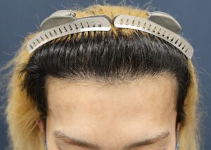 【2回目】術後1年