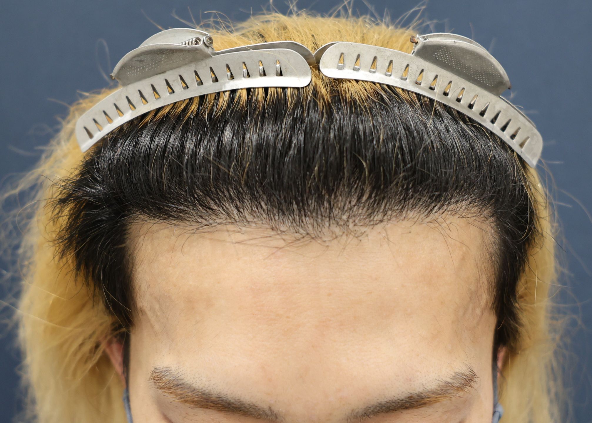 【2回目】術後1年