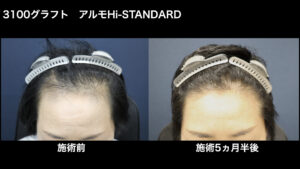 【症例経過】自毛植毛　アルモHi-STANDARD法　 3100グラフト　生え際　術後5ヵ月半｜東京 自毛植毛 アルモ形成クリニック 美容外科 院長 内田直宏 先生の施術