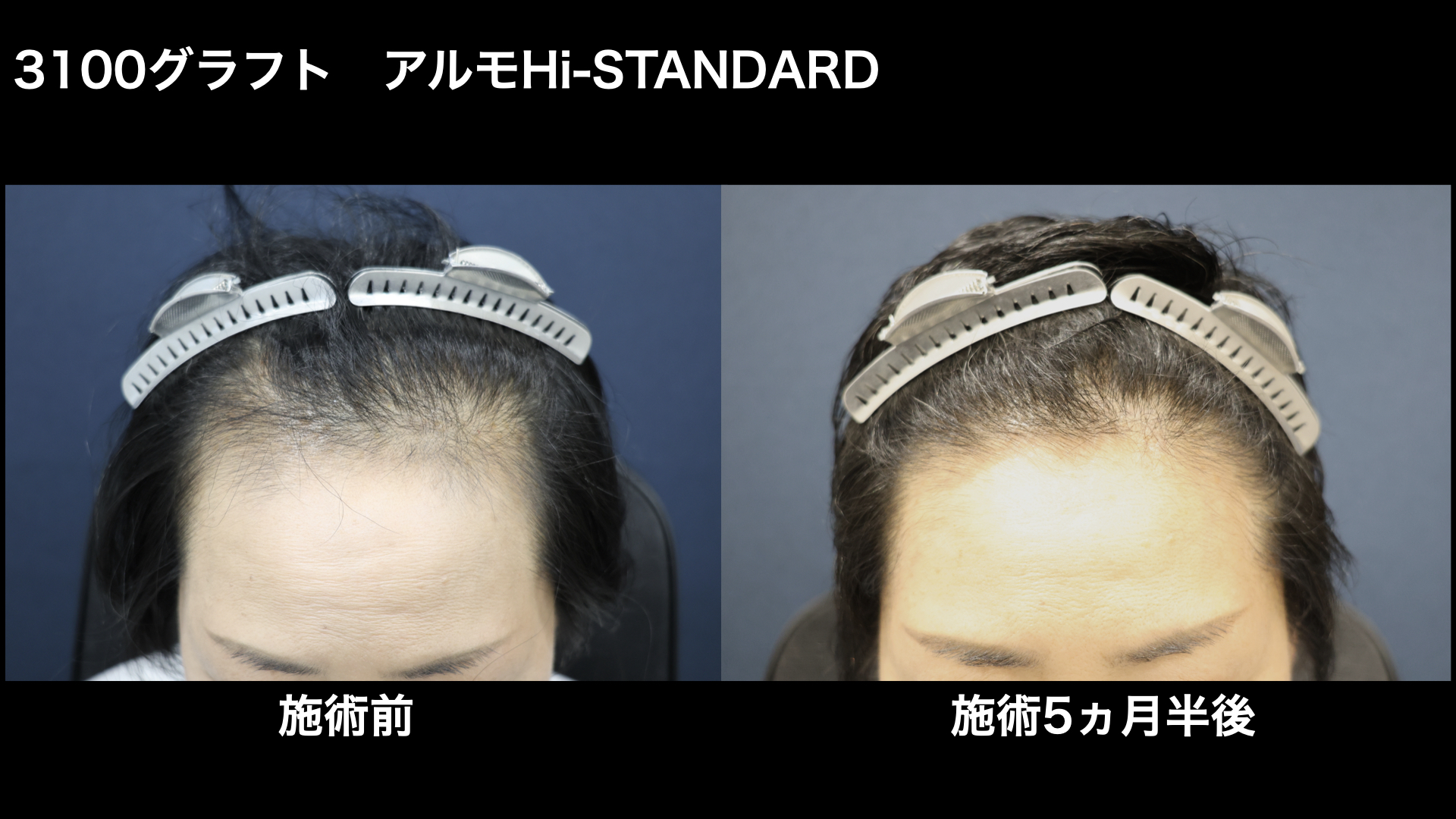 【症例経過】自毛植毛　アルモHi-STANDARD法　 3100グラフト　生え際　術後5ヵ月半｜東京 自毛植毛 アルモ形成クリニック 美容外科 院長 内田直宏 先生の施術