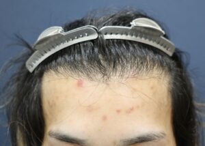 【1回目】施術前