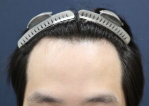 【1回目】施術前