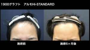【症例経過】自毛植毛　アルモHi-STANDARD法 1900グラフト　生え際　術後6ヵ月｜東京 自毛植毛 アルモ形成クリニック 美容外科 院長 内田直宏 先生の施術