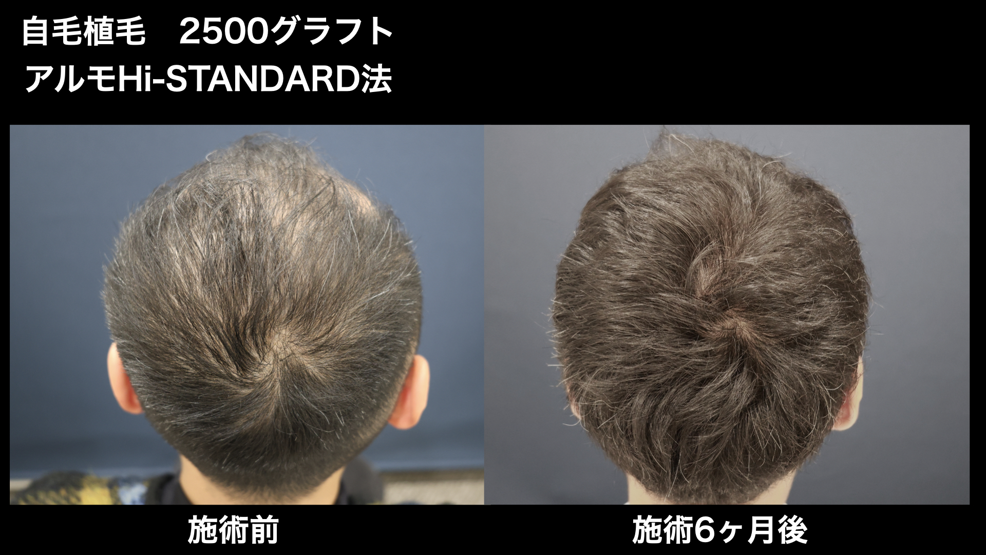 【症例経過】自毛植毛　アルモHi-STANDARD法 2500グラフト　全体広範囲　術後6ヵ月｜東京 自毛植毛 アルモ形成クリニック 美容外科 院長 内田直宏 先生の施術
