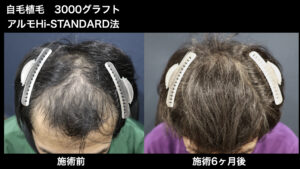 【症例経過】自毛植毛　アルモHi-STANDARD法 3000グラフト　全体広範囲　術後6ヵ月｜東京 自毛植毛 アルモ形成クリニック 美容外科 院長 内田直宏 先生の施術