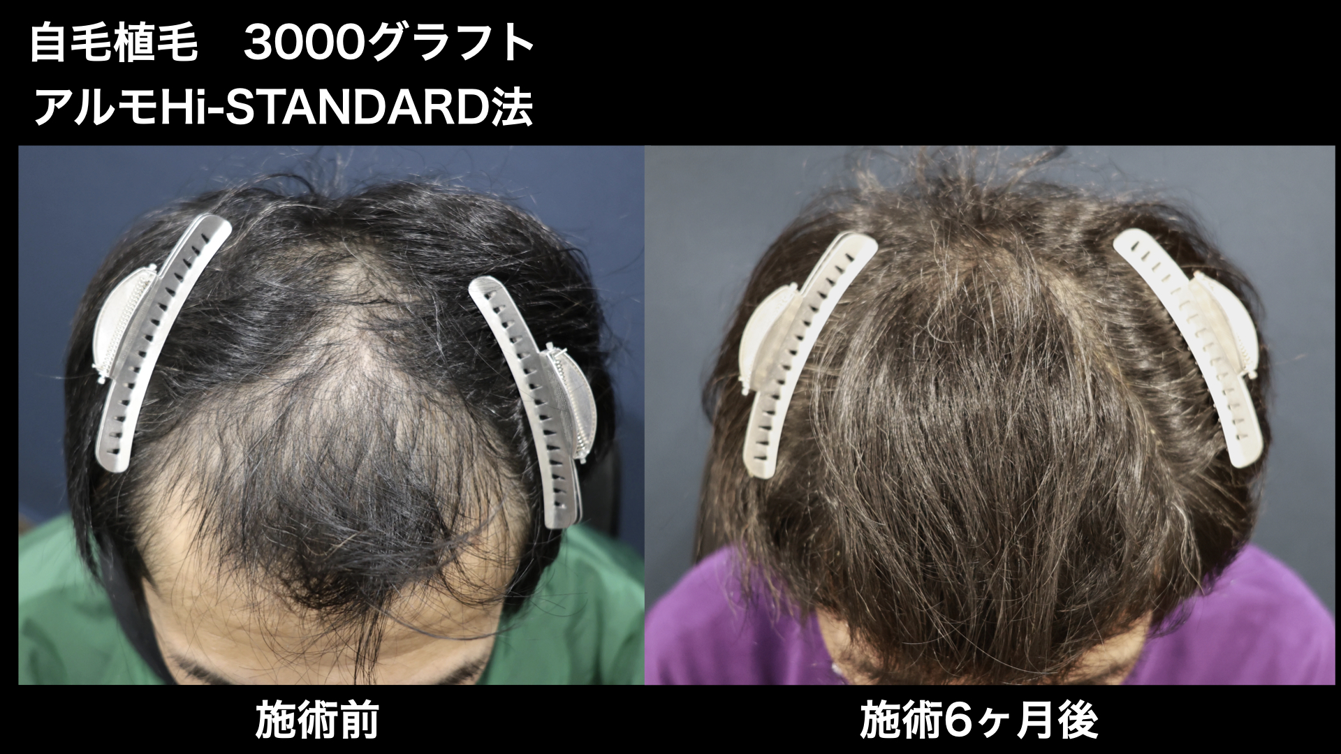 【症例経過】自毛植毛　アルモHi-STANDARD法 3000グラフト　全体広範囲　術後6ヵ月｜東京 自毛植毛 アルモ形成クリニック 美容外科 院長 内田直宏 先生の施術