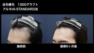 【症例経過】自毛植毛　アルモHi-STANDARD法 1300グラフト　Ｍ字　術後6ヵ月｜東京 自毛植毛 アルモ形成クリニック 美容外科 院長 内田直宏 先生の施術
