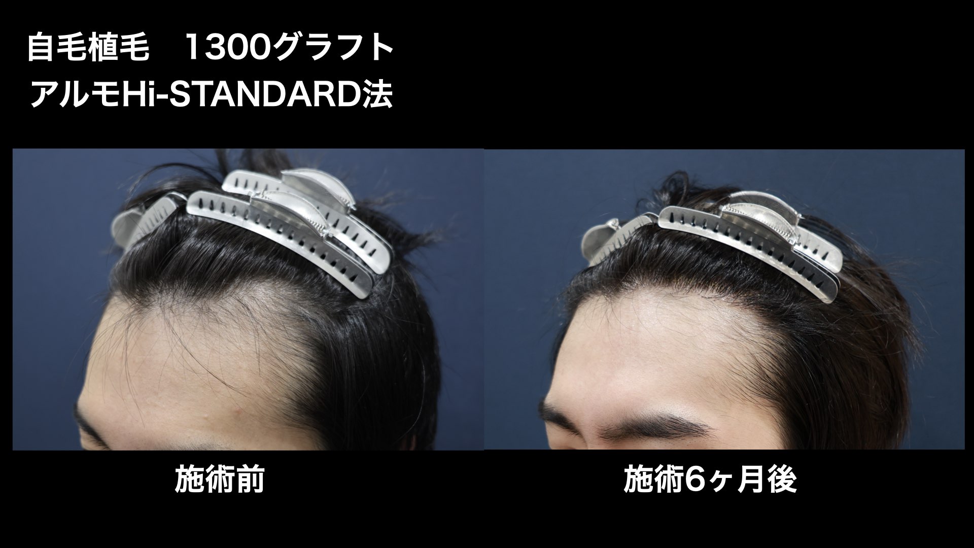 【症例経過】自毛植毛　アルモHi-STANDARD法 1300グラフト　Ｍ字　術後6ヵ月｜東京 自毛植毛 アルモ形成クリニック 美容外科 院長 内田直宏 先生の施術