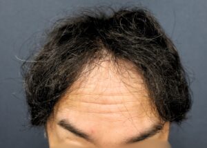 【2回目】術後1年