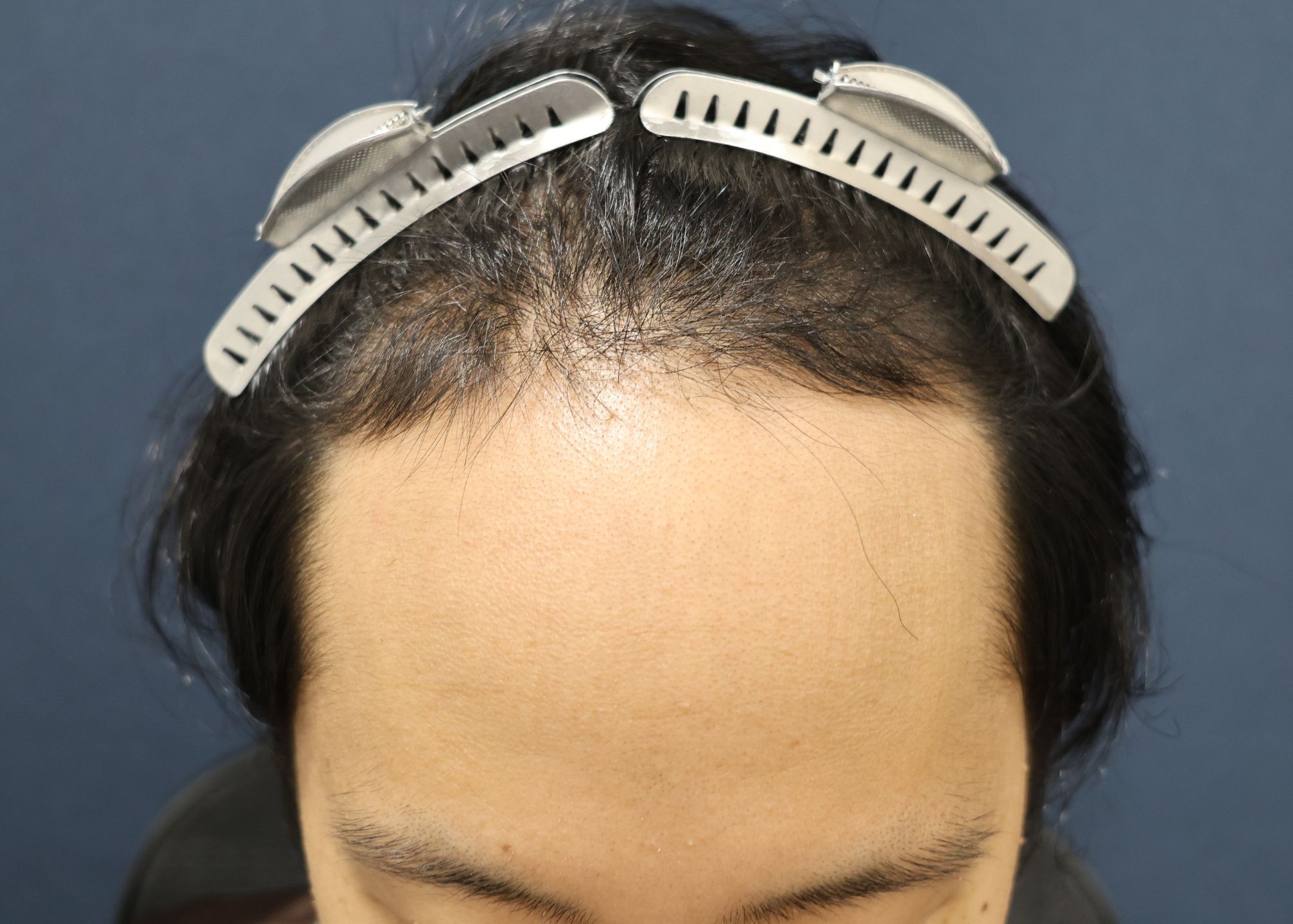 【1回目】施術前