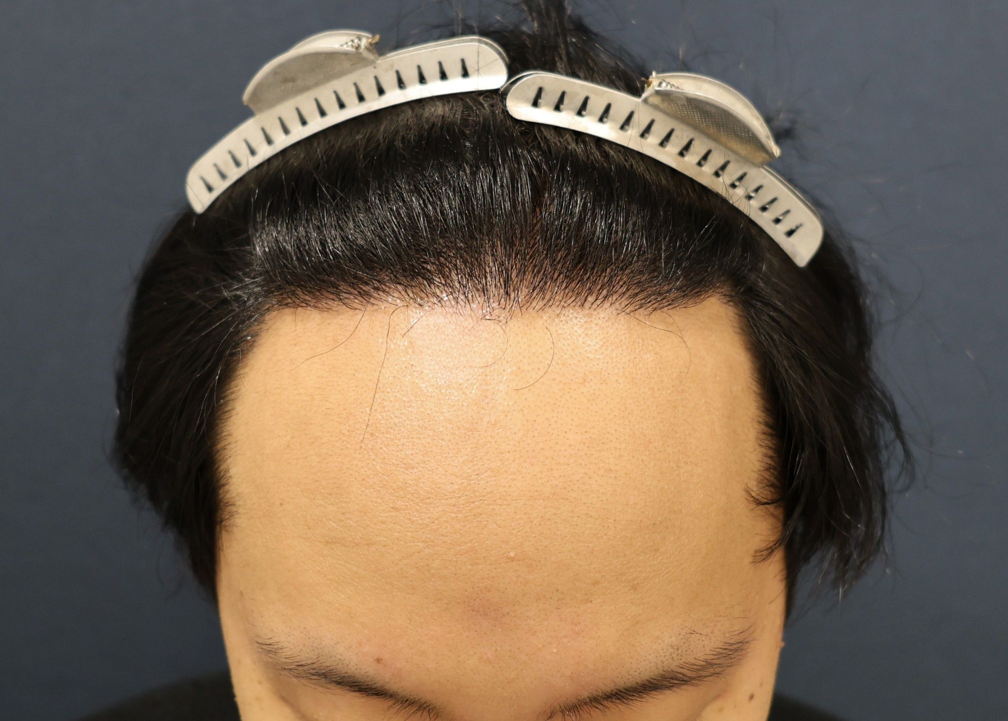 【2回目】術後6ヶ月