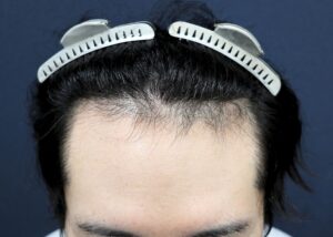 【2回目】術後1年